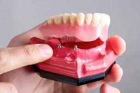 Advantages of Dental Implants Over Dentures