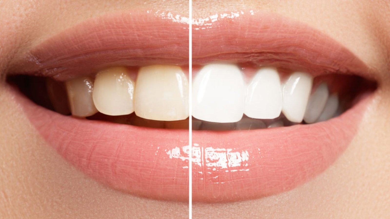 Affordable Teeth Whitening Treatments Near Me