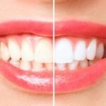 Are There Any Risks Associated with Teeth Whitening?