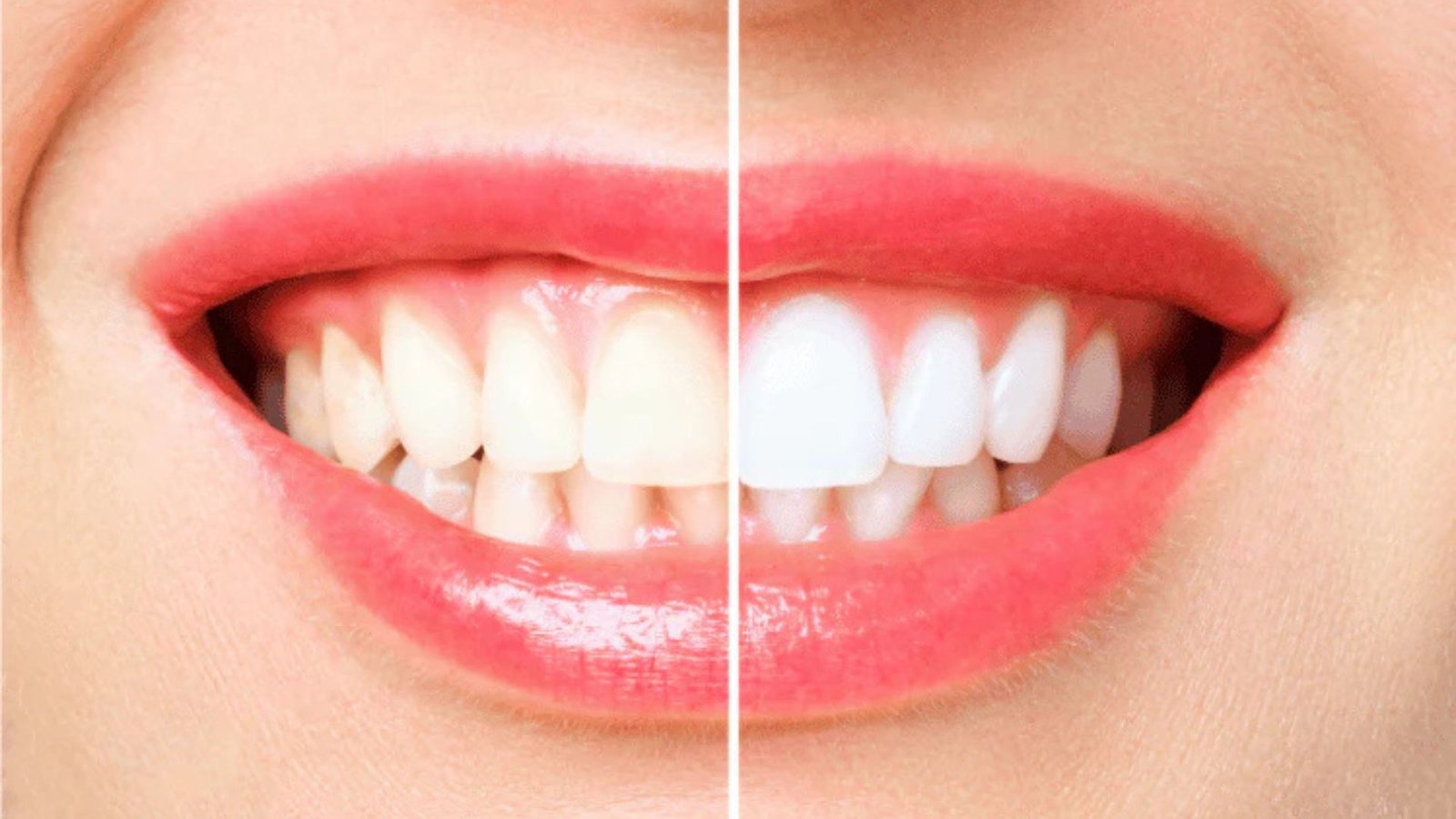 Are There Any Risks Associated with Teeth Whitening?