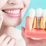 Benefits Of Dental Implants For Missing Teeth