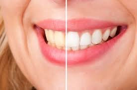 Best Methods for Professional Teeth Whitening