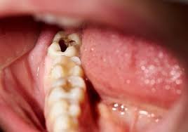 Common Oral Health Problems and How to Prevent Them