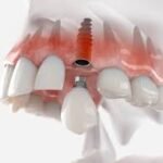 Dental Implant Procedure: Step-by-Step Guide