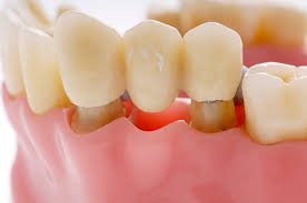 Dental Implants vs. Bridges: Which is Better?