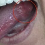 How Dentists Detect Early Signs of Oral Cancer