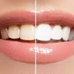 How Diet Affects Your Teeth Whitening Results