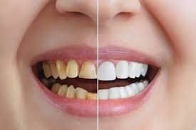 How Long Does Teeth Whitening Last?