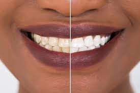 How Long Does Teeth Whitening Last?