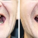 How Much Do Dental Implants Cost