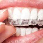 How To Get Whiter Teeth Naturally