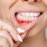 How to Identify the Early Signs of Gum Disease
