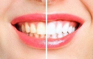 How to Maintain a Bright Smile After Whitening