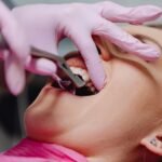 How to Prepare for Wisdom Teeth Removal