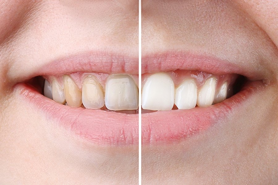 In-Office Teeth Whitening vs. At-Home Kits