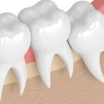 Is Oral Surgery Necessary for Impacted Wisdom Teeth?