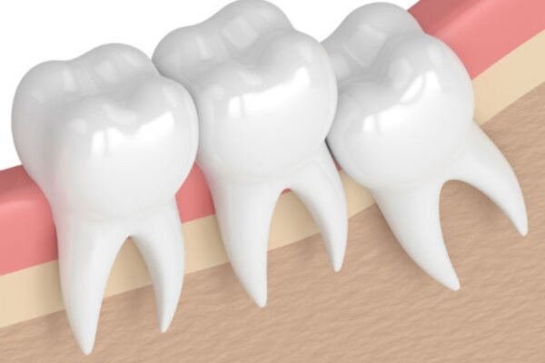 Is Oral Surgery Necessary for Impacted Wisdom Teeth?