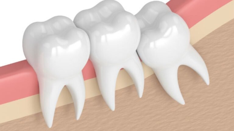 Is Oral Surgery Necessary for Impacted Wisdom Teeth?