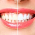 Natural Teeth Whitening Methods: Are They Effective?
