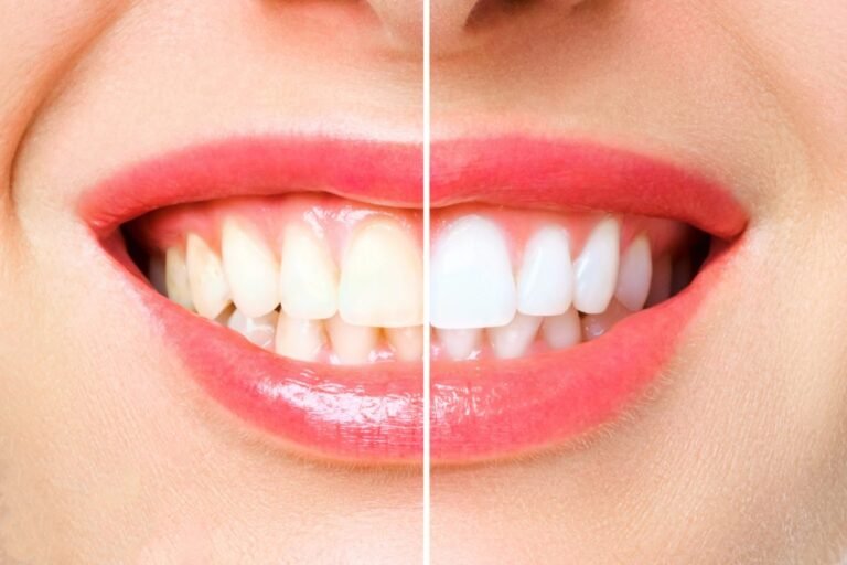 Natural Teeth Whitening Methods: Are They Effective?