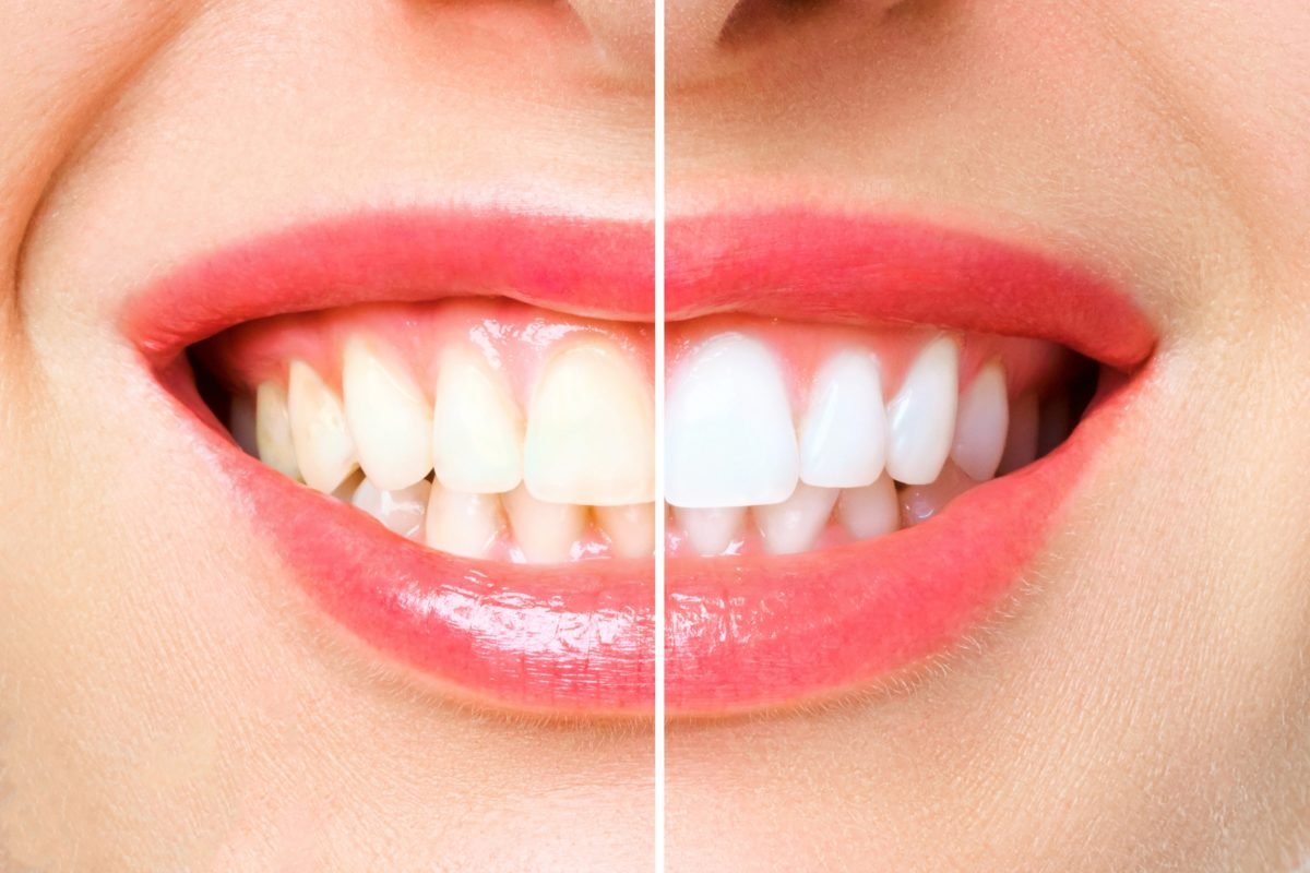 Natural Teeth Whitening Methods: Are They Effective?