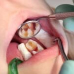 Oral Health Tips For Preventing Cavities