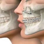 Oral Surgery To Correct Jaw Misalignment