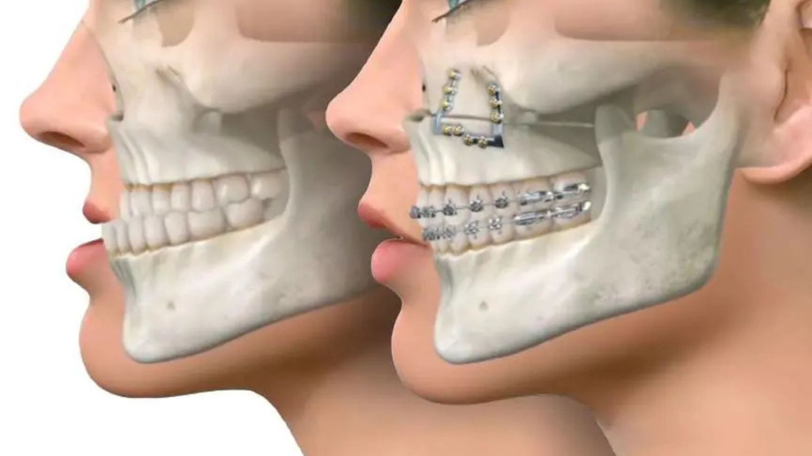 Oral Surgery To Correct Jaw Misalignment