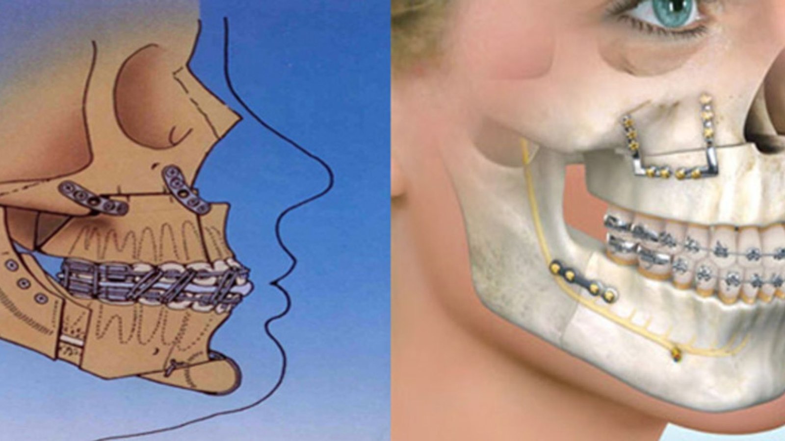 Oral Surgery To Correct Jaw Misalignment