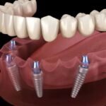 Oral Surgery for Dental Implants: What You Need to Know
