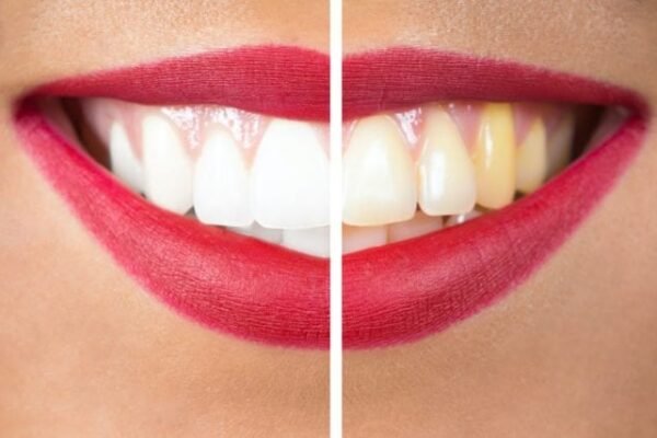 Teeth Whitening Myths Debunked