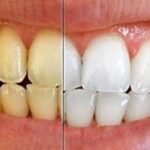 Teeth Whitening Without Damaging Enamel Tips.