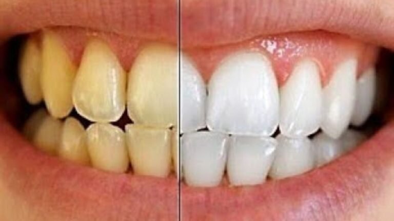 Teeth Whitening Without Damaging Enamel Tips