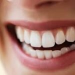 Teeth Whitening for Sensitive Teeth: What to Know