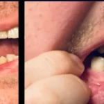 The Basics of Dental Implants: What You Need to Know