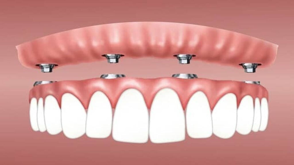 The Benefits of Choosing Dental Implants Over Dentures