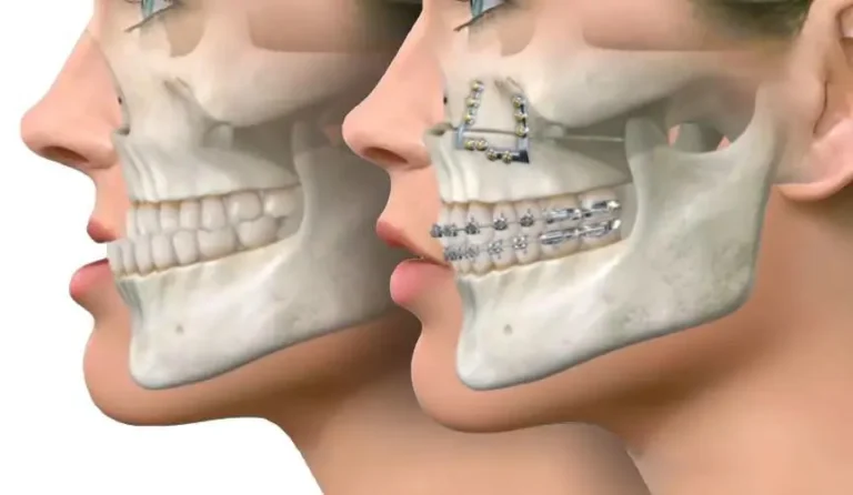 The Benefits of Corrective Jaw Surgery