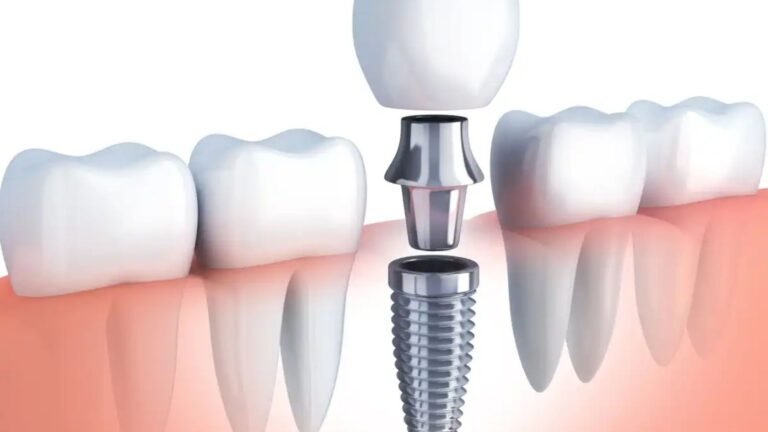 The Cost of Dental Implants Is It Worth the Investment