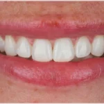 The Dangers of Overusing Teeth Whitening Products,,