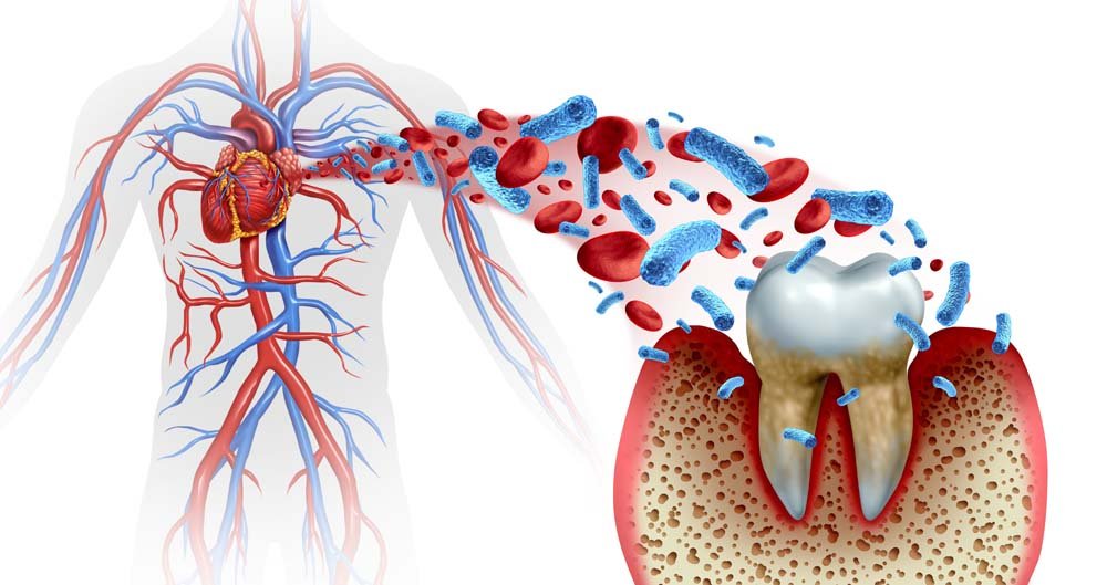 The Effects of Poor Oral Hygiene on Your Heart Health