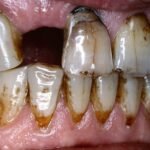 The Impact of Smoking on Your Teeth and Gums