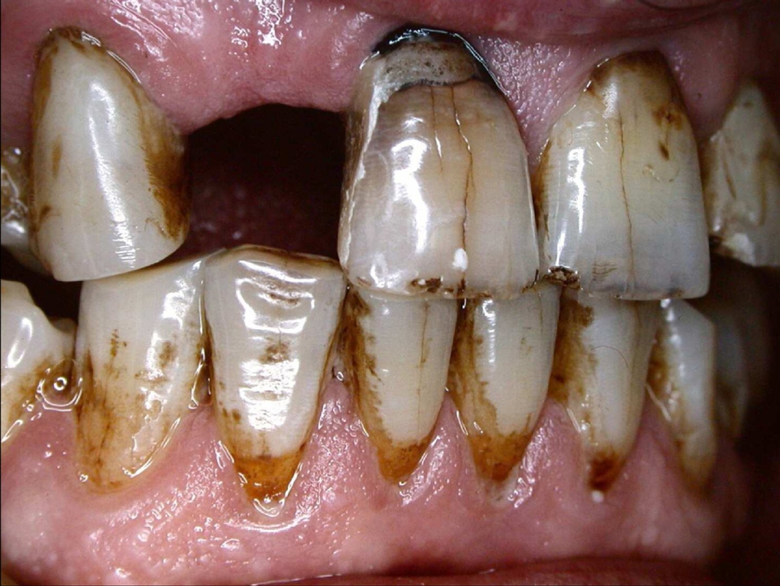 The Impact of Smoking on Your Teeth and Gums