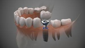 The Lifespan of Dental Implants: What to Expect