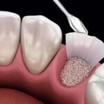 The Most Common Types of Oral Surgery Procedures