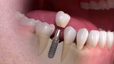 The Process of Getting a Dental Implant