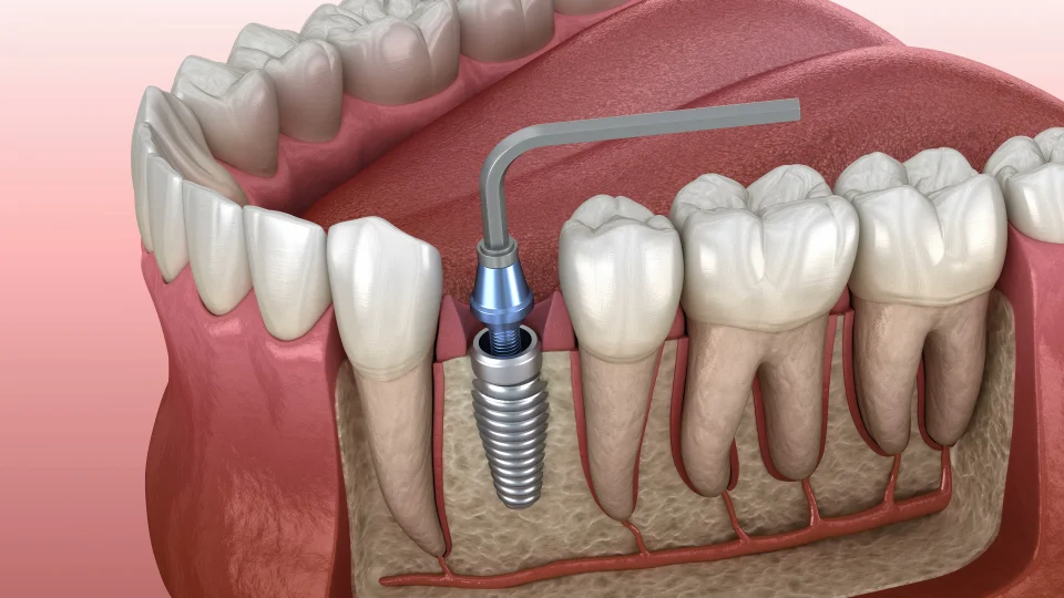 The Process of Getting a Dental Implant