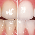 The Pros and Cons of Professional vs. At-Home Teeth Whitening