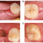 The Recovery Process After Oral Surgery