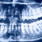 The Recovery Process After Oral Surgery: Tips and Timeline