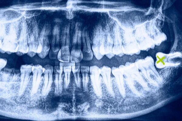 The Recovery Process After Oral Surgery: Tips and Timeline